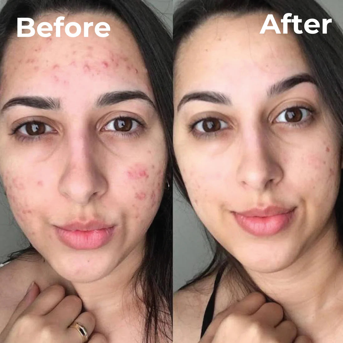 Trubella Skin Brightening Cream before after results