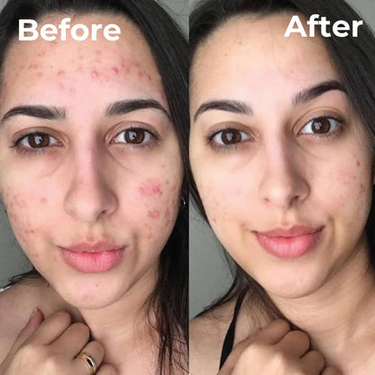 Trubella Skin Brightening Cream before after results